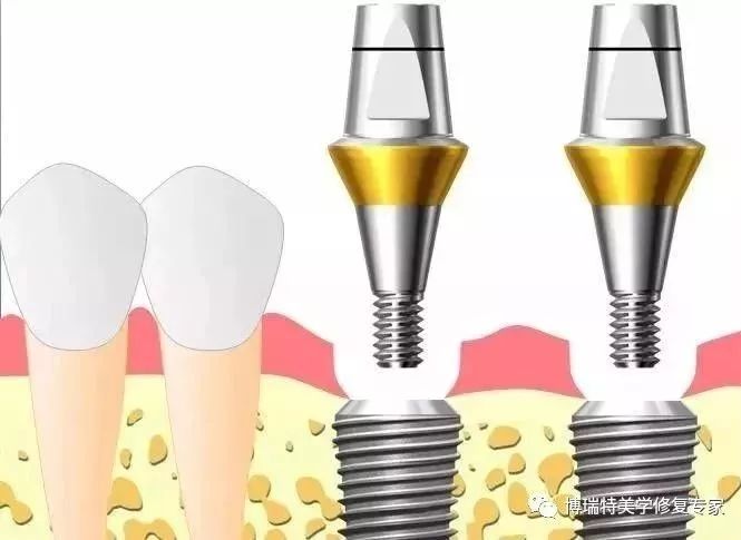 口腔种植印模及种植修复取模图解