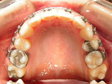 如上图所示,在矫正期间由于做带环的牙齿和前后牙之间容易嵌塞食物