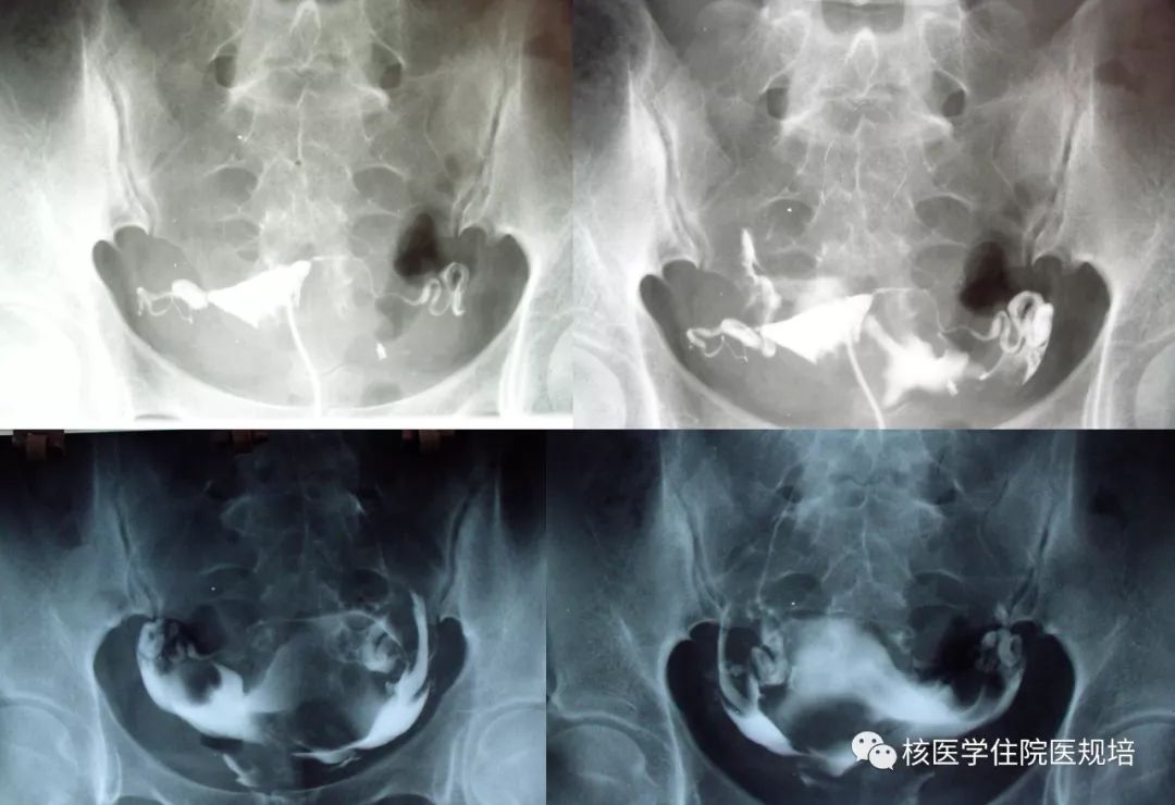 顺利,宫腔形态大致正常,双侧输卵管走行可,通畅,盆腔内造影剂弥散良好