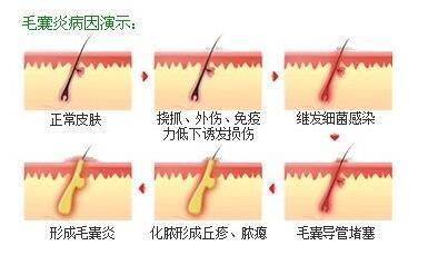 得了男性外生殖器毛囊炎别着急,看了这文章就清楚了