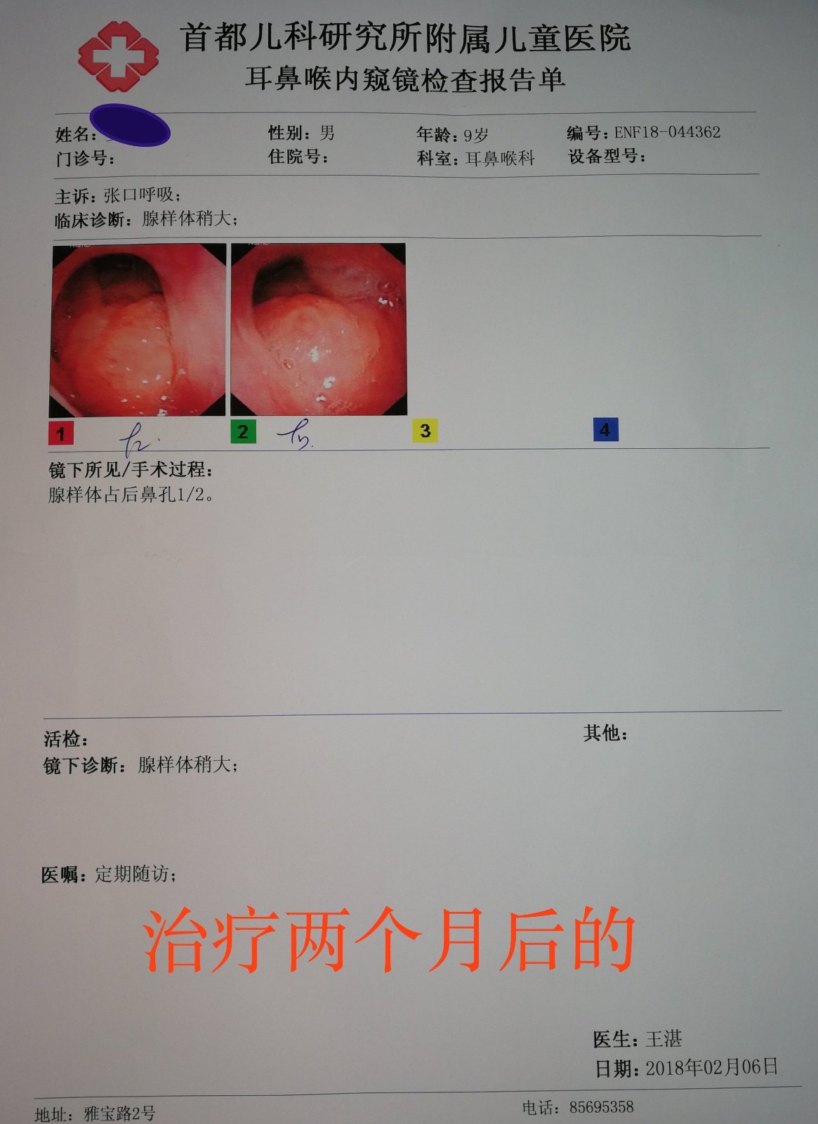 中医药治疗腺样体肥大的案例分享