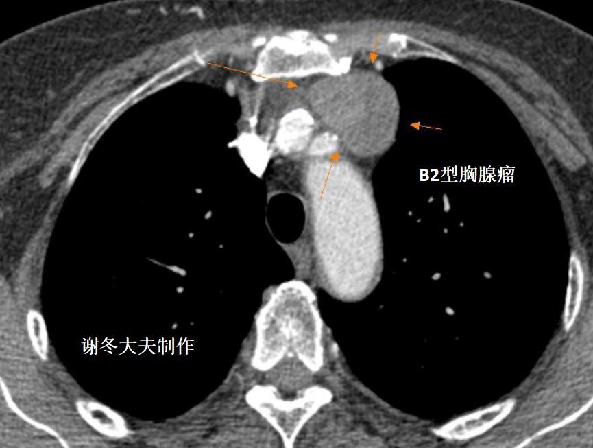 胸腺瘤前纵隔占位前纵隔结节是癌症吗