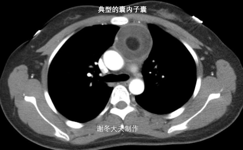 胸腺瘤前纵隔占位前纵隔结节是癌症吗