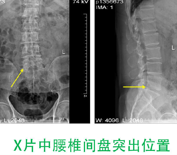 椎间孔镜治疗l5/s1极外侧型腰椎间盘突出症