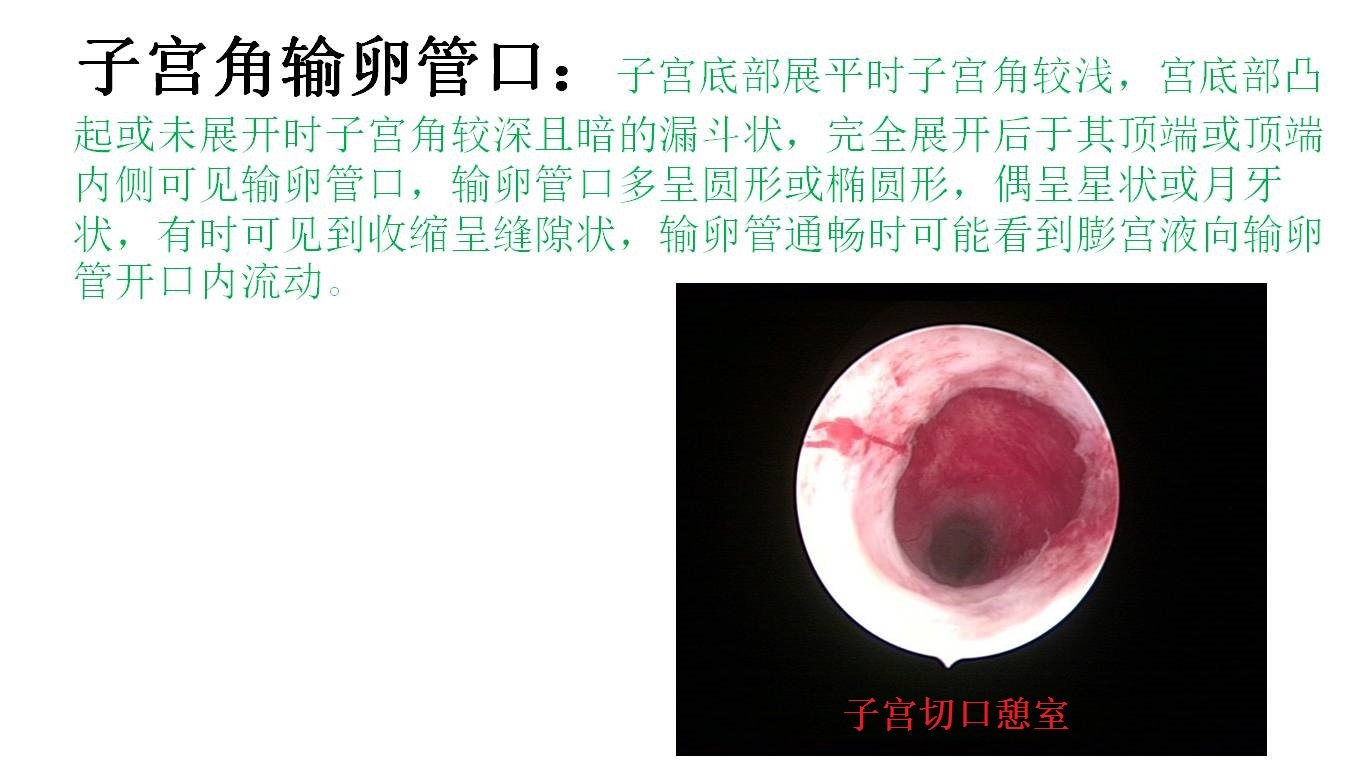 正常宫腔描述及异常宫腔图片(图文不对应)