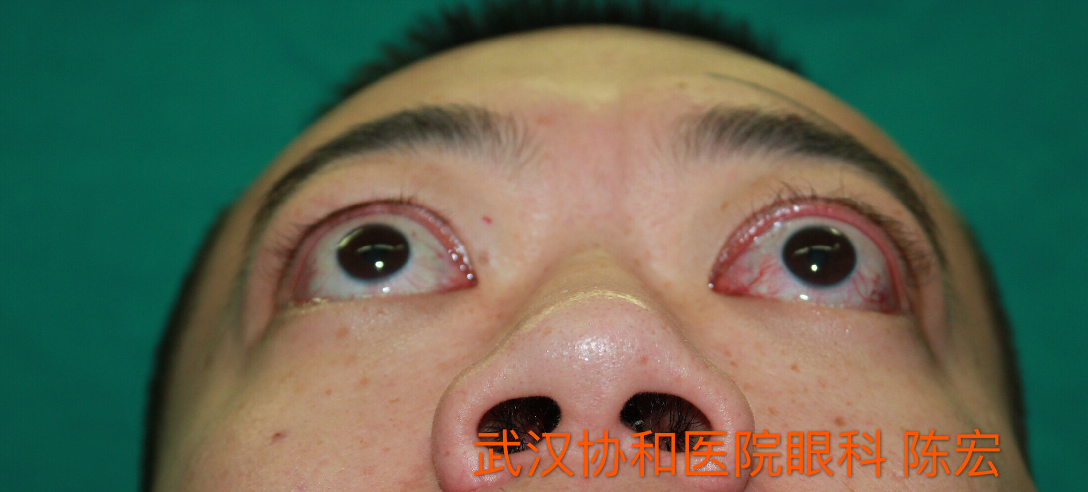 术前病情  双眼眼球突出,眼睑闭合不全,左眼暴露性角膜溃疡