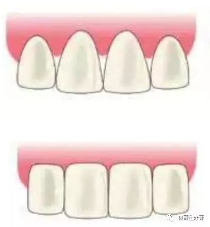 牙齿上的"黑三角",你知道多少?_牙龈