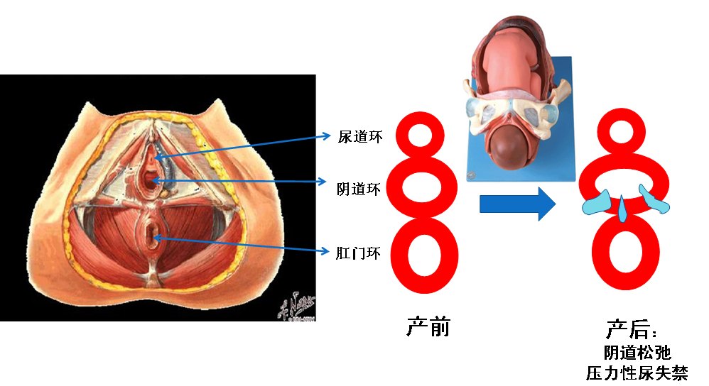 为什么缩阴要做手术才有用?