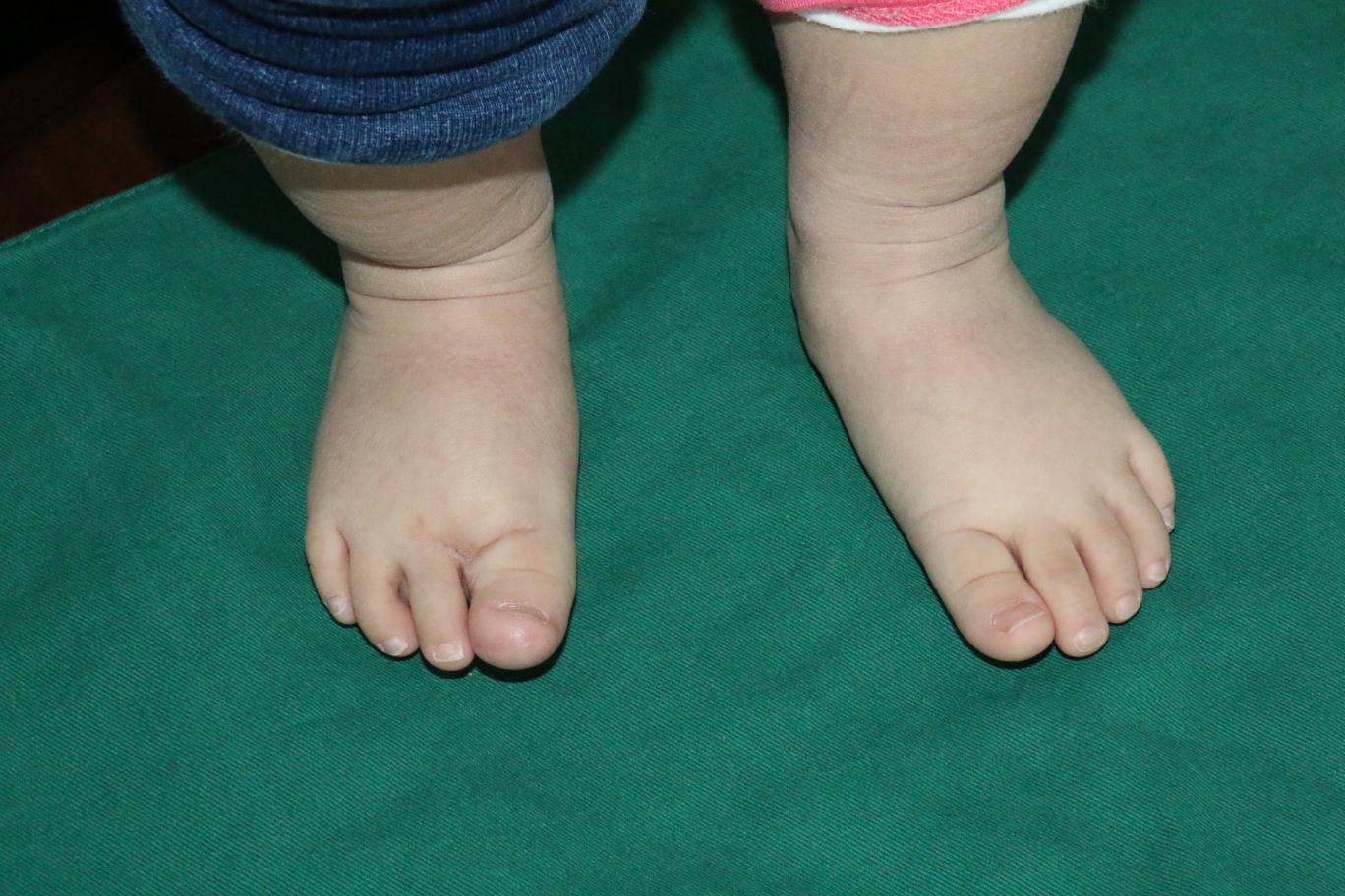 小孩脚趾头变形的图片-图库-五毛网