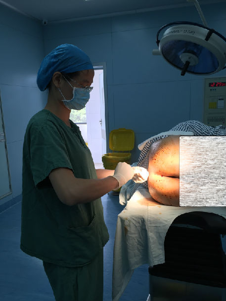 刘付医生手术:重度环状混合痔,陈旧性肛裂,肛门狭窄手术