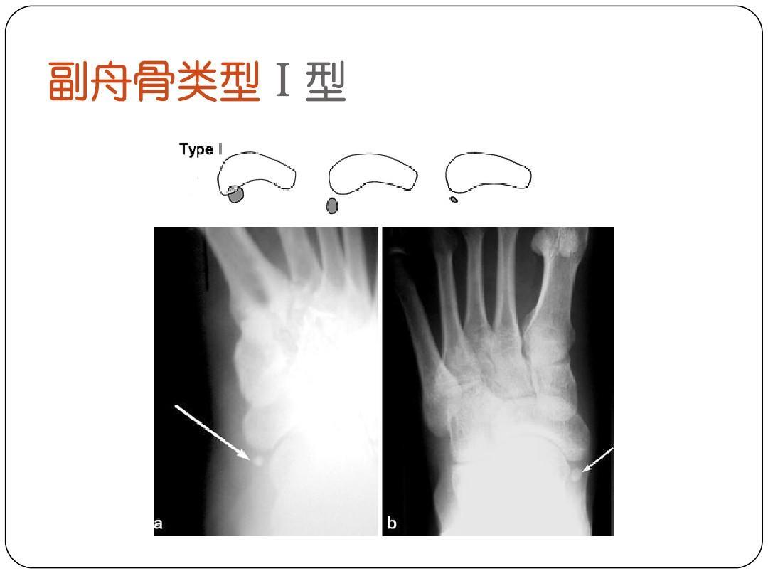 副舟骨综合症