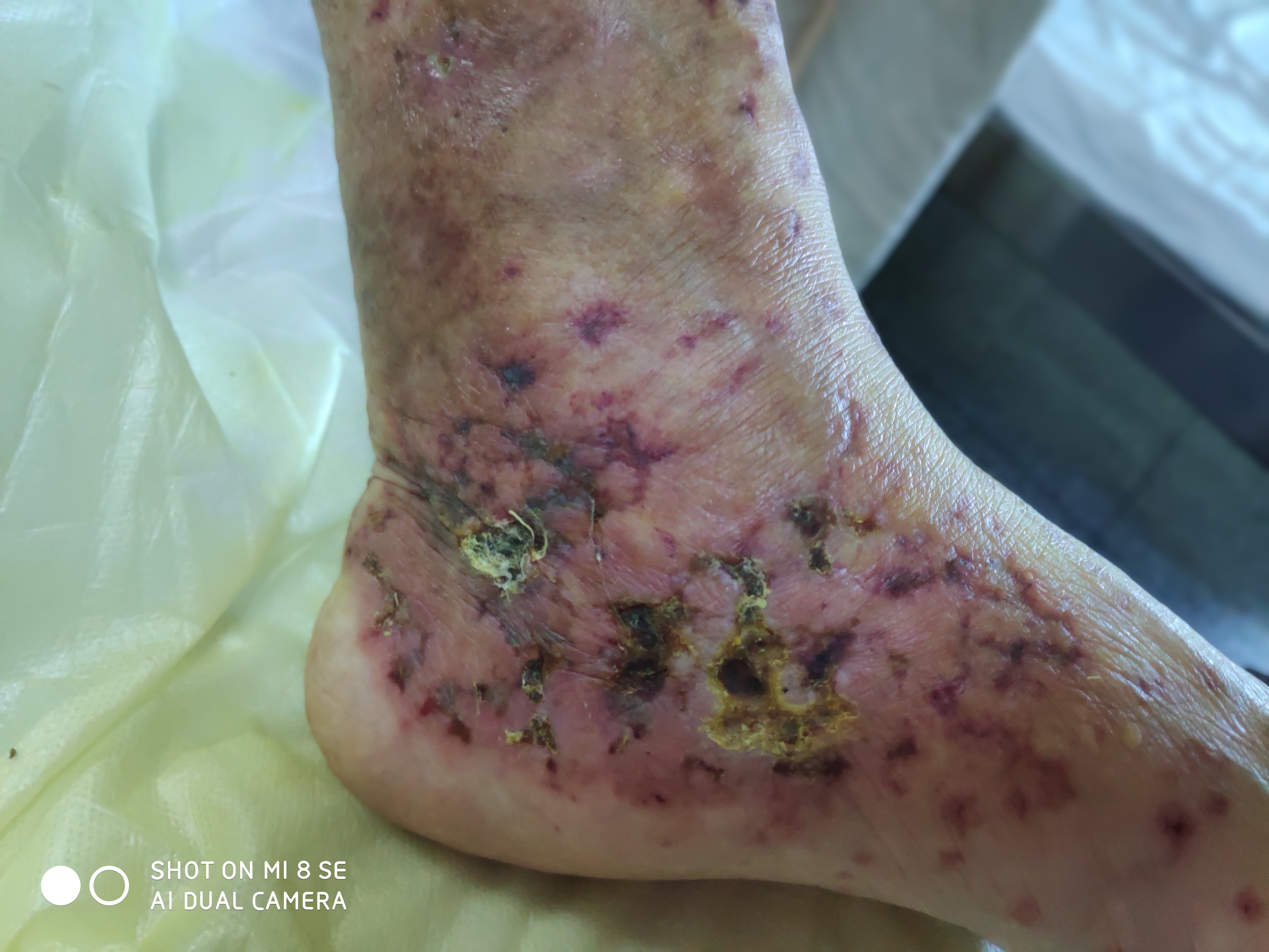 后皮疹反复发作,并发绿脓杆菌感染皮疹加重,下肢出现淤点淤斑及坏死