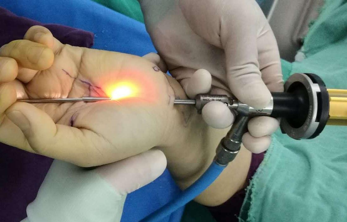 关节镜微创治疗腕管综合征