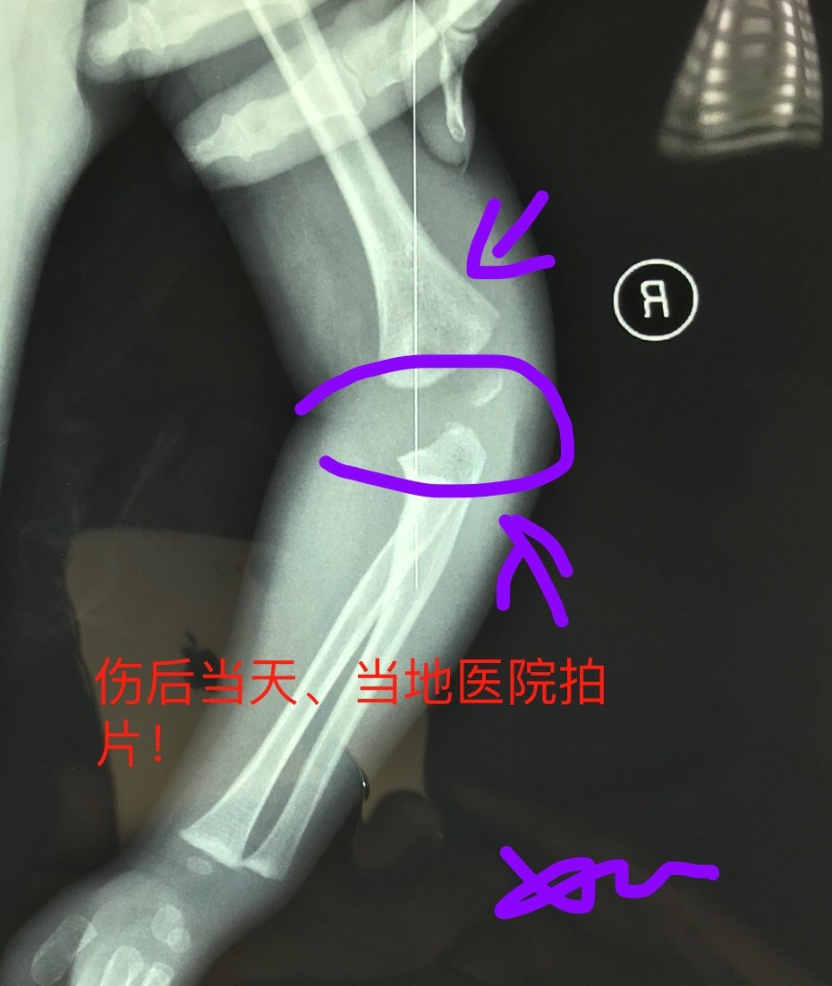 易漏诊的婴幼儿肱骨远端全骨骺分离_关节