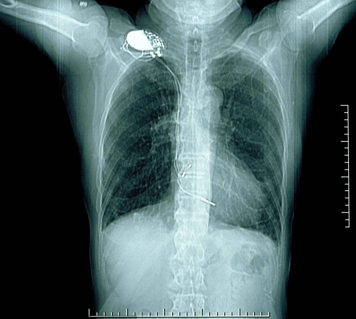 面对肺癌核磁检查和ct检查该如何选择