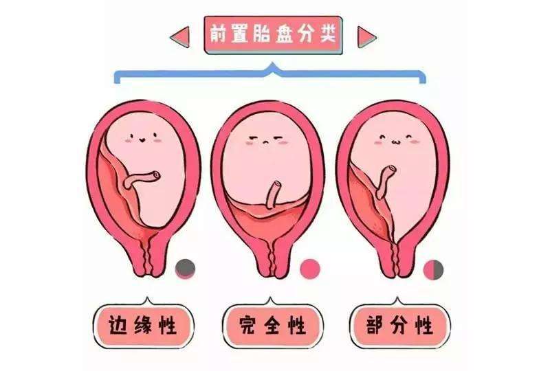 前置胎盘真的这么危险孕妇前置胎盘怎么办