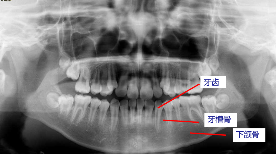 牙齿不光有我们口内能看到的部分,还有长长的牙根埋在牙槽骨里,就像树
