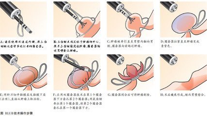 胃肠道间质瘤内镜微创治疗