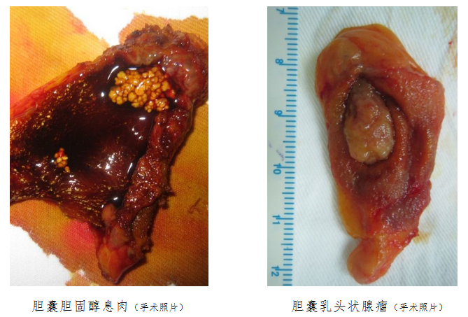 肝胆外科医学科普2胆囊息肉的治疗