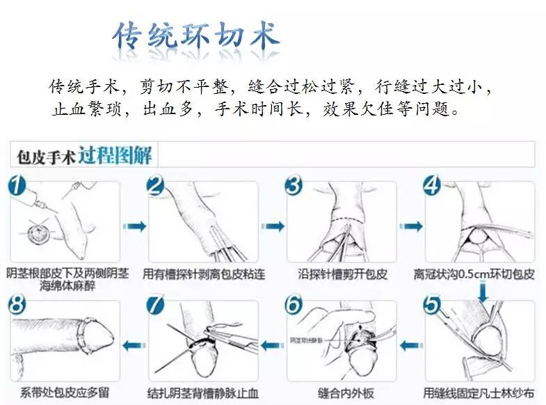 只有小器官,没有小手术——包皮环切术与男性健康 (转载)