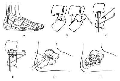 跟骨骨折的治疗 (转载)