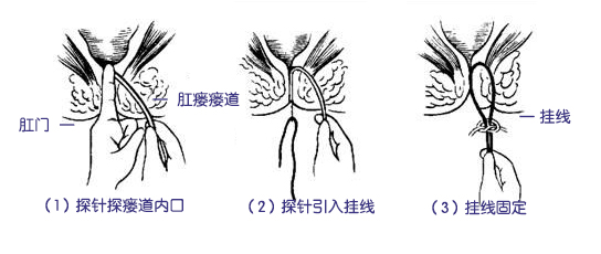 肛瘘长肉芽,是伤口快愈合了吗?