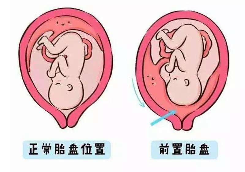 孕妇前置胎盘怎么办?