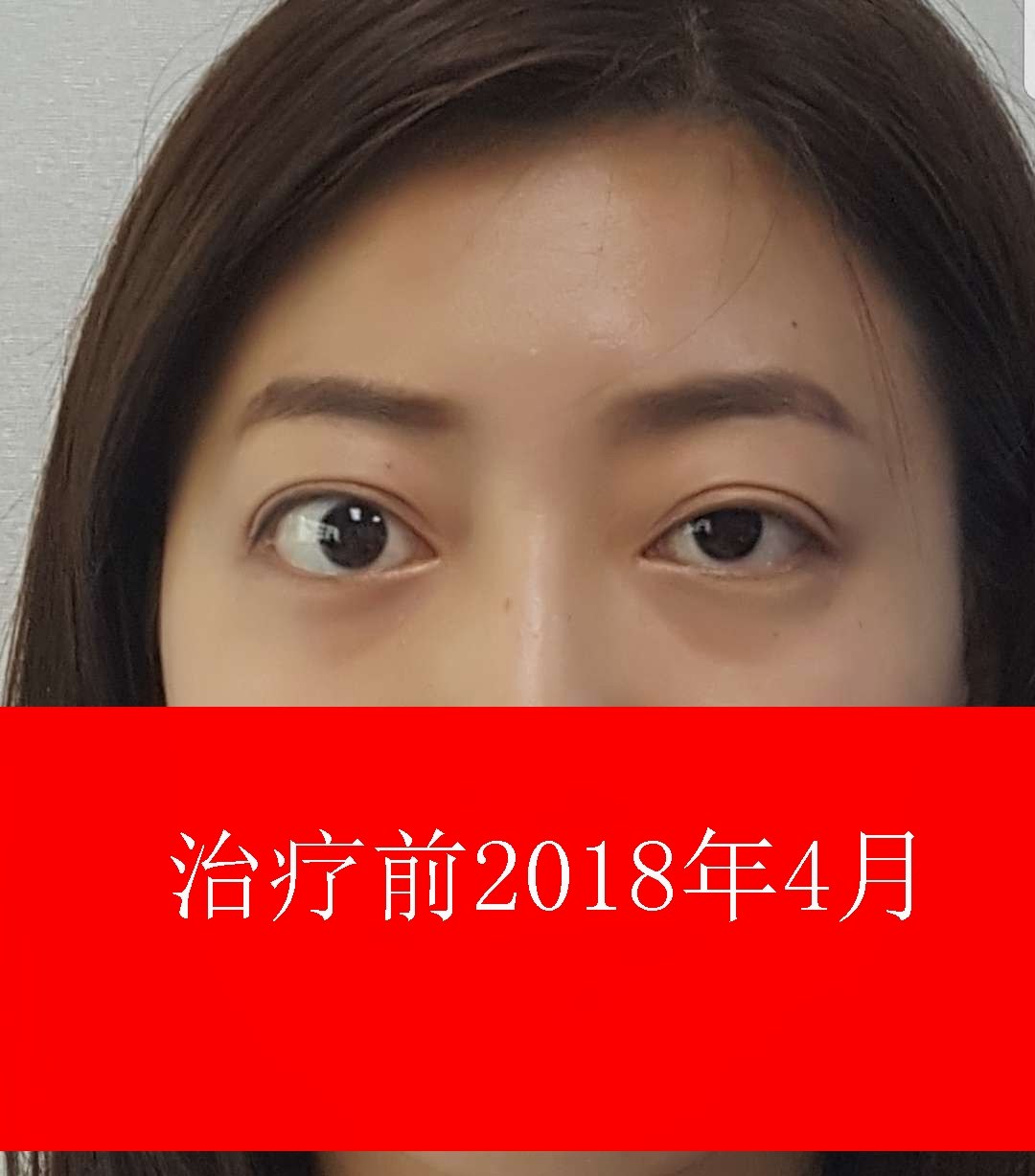 近期甲亢突眼患者治疗对照照片