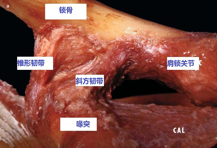 断层解剖研究发现,肩锁关节上韧带在抵抗锁骨远端向后移位中起到56%的