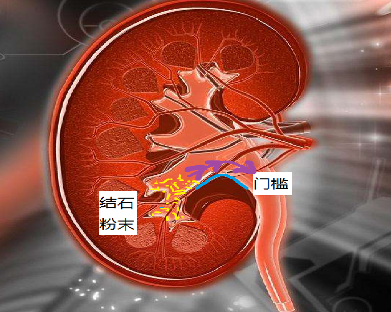 输尿管软镜碎石术后体位排石小知识