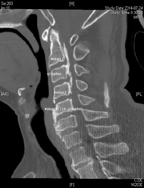 颈椎损伤 脊髓损伤 后纵韧带骨化 寰枢椎不稳