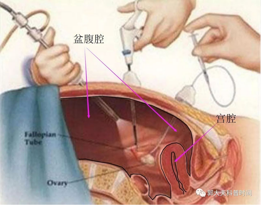 如子宫内膜息肉,粘膜下肌瘤,纵隔子宫,宫腔粘连,节育器残留等