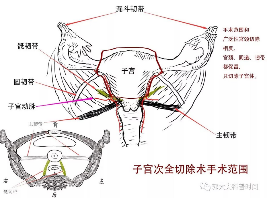 子宫楔形切除术