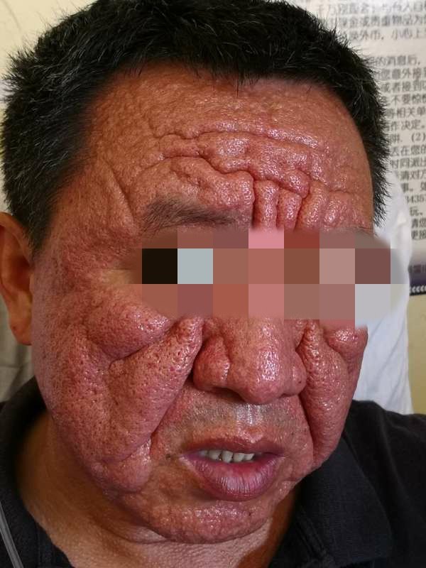治疗前,患者面部多发结节丘疹,潮红肿胀明显