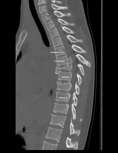 胸椎骨折