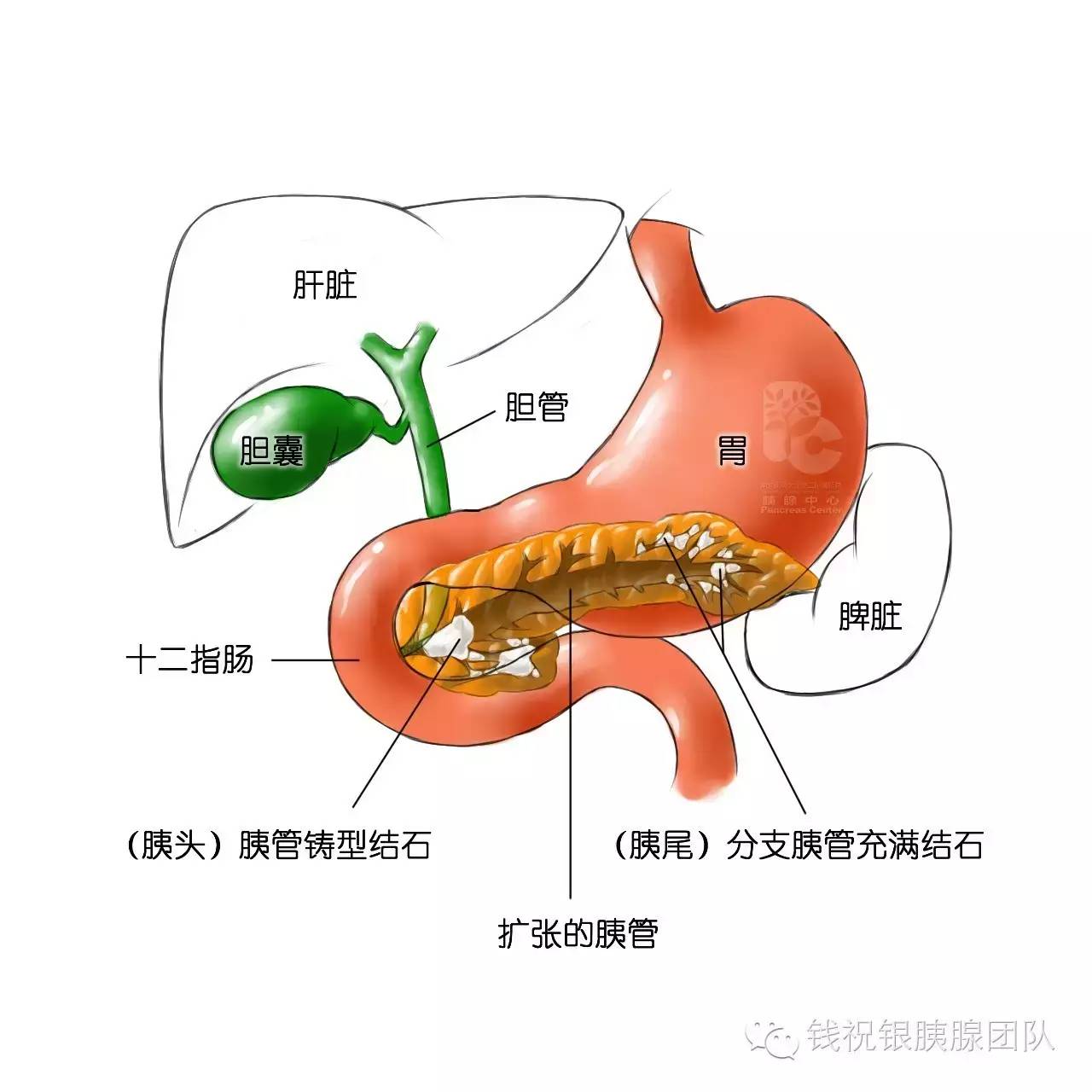 保留中段的胰腺切除术 (转载)