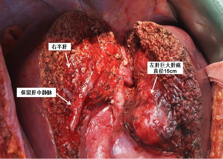 解剖性左半肝切除术治疗左肝巨大肝癌