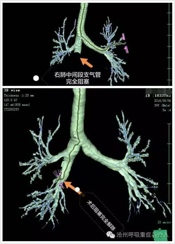 支气管内肿瘤切除病例分享