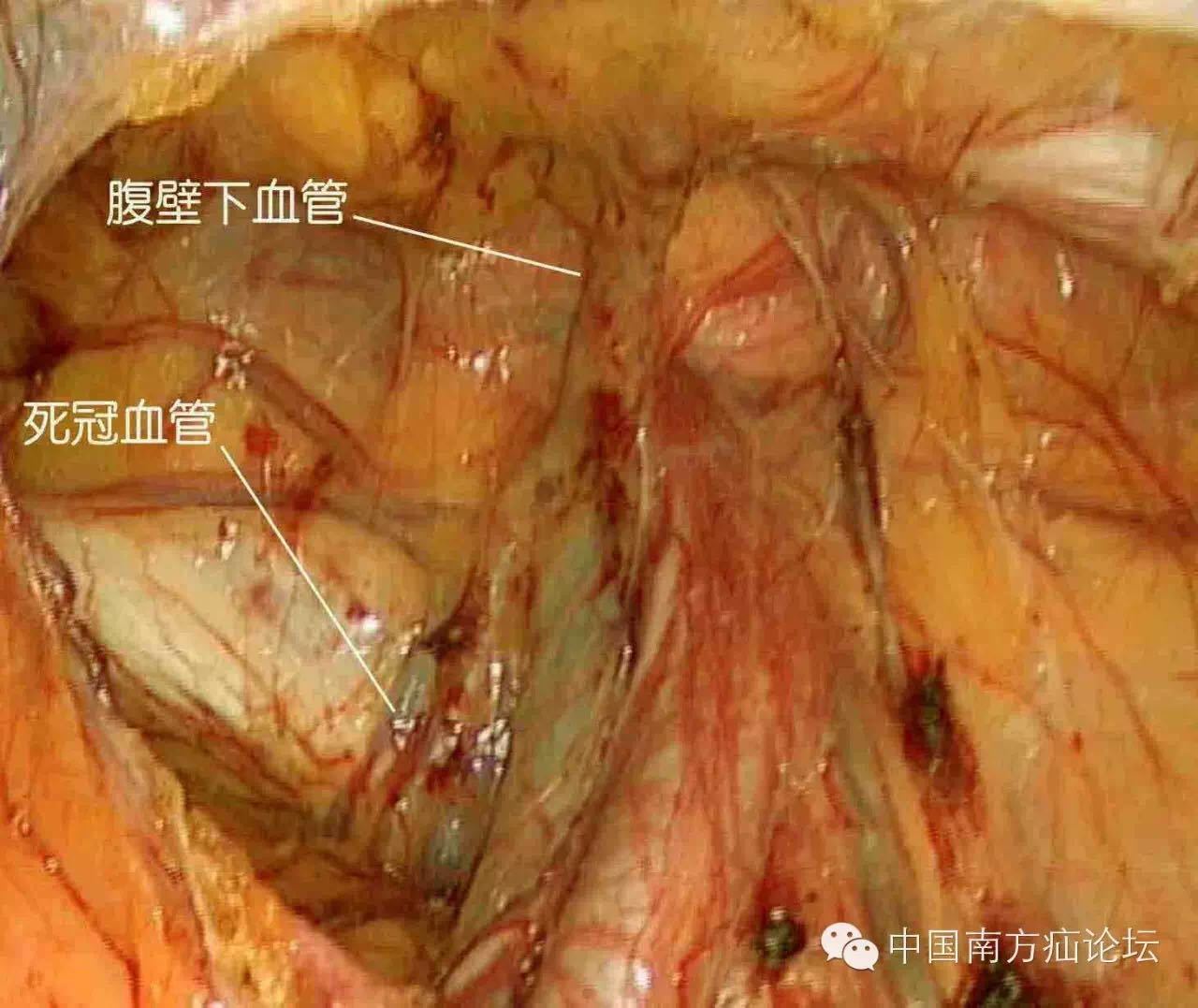 基础|腔镜下腹股沟解剖(三)危险与"坑" (转载)