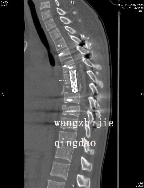 胸椎骨折