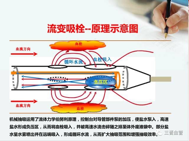 血栓抽吸转载