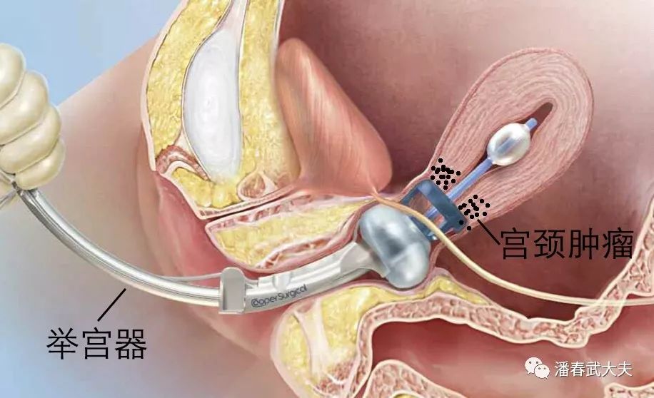 下面是举宫器使用的示意图