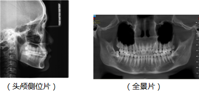 矫正牙齿一定要拍摄x光片?