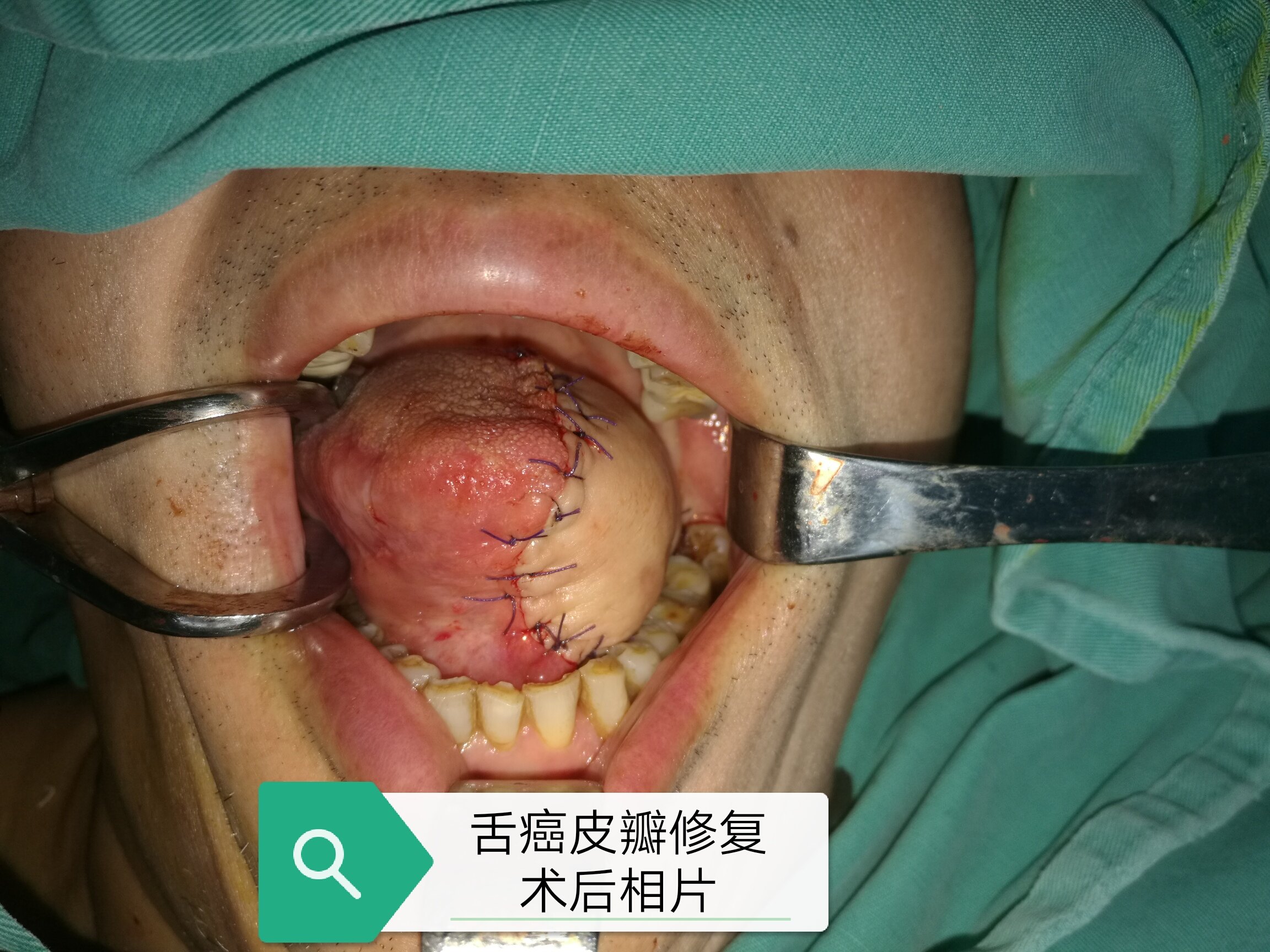 舌癌患者术前准备和术后注意事项(附图片)