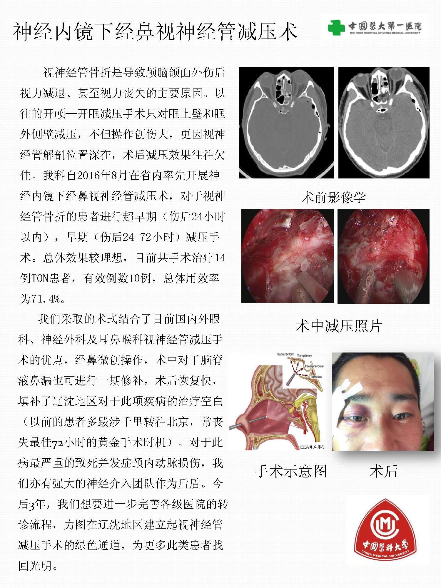 神经内镜下经鼻视神经管减压术挽救外伤后失明的新技术