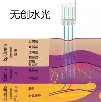 关于无创水光的八大疑问一次给你说明白