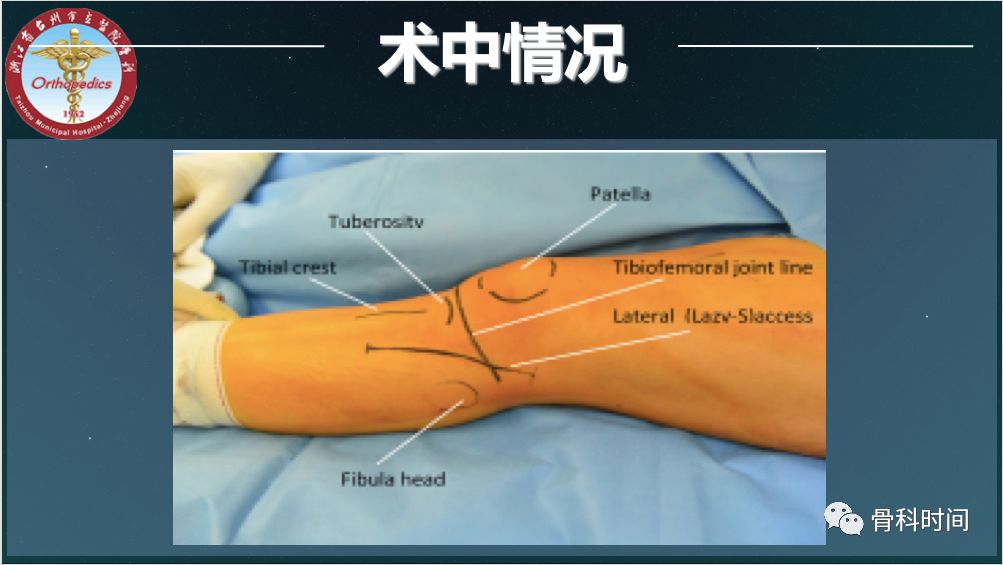 这例胫骨平台骨折,你怎么看?