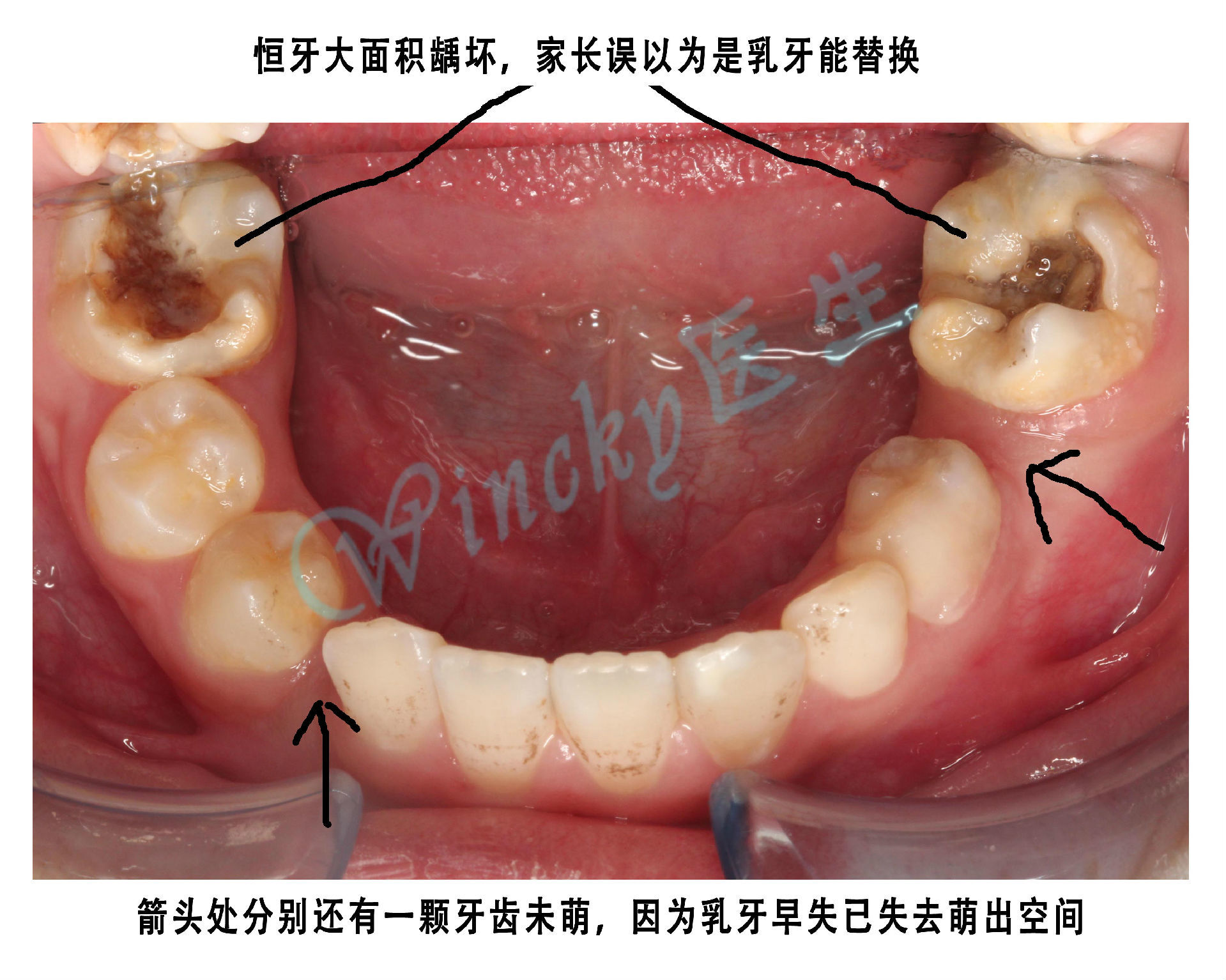 乳牙坏了到底要不要治?——乳牙龋齿的危害