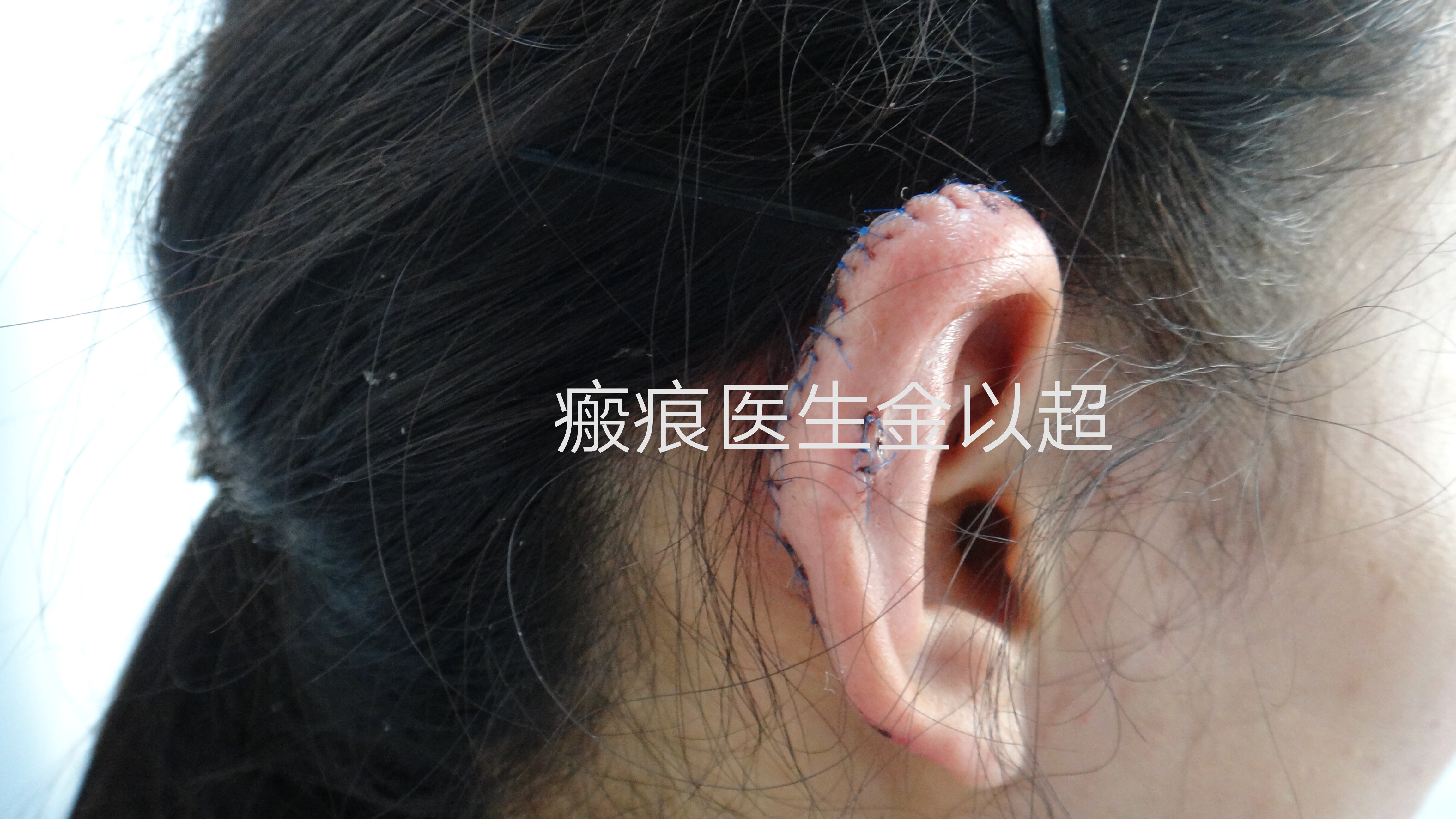 耳朵瘢痕疙瘩的治疗