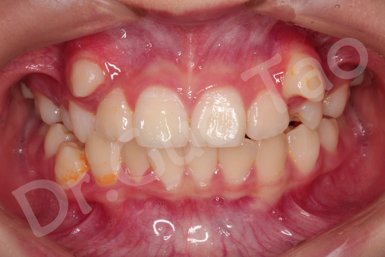 口内正面照片,帮助医生判断前面牙齿的错位情况以及咬合关系